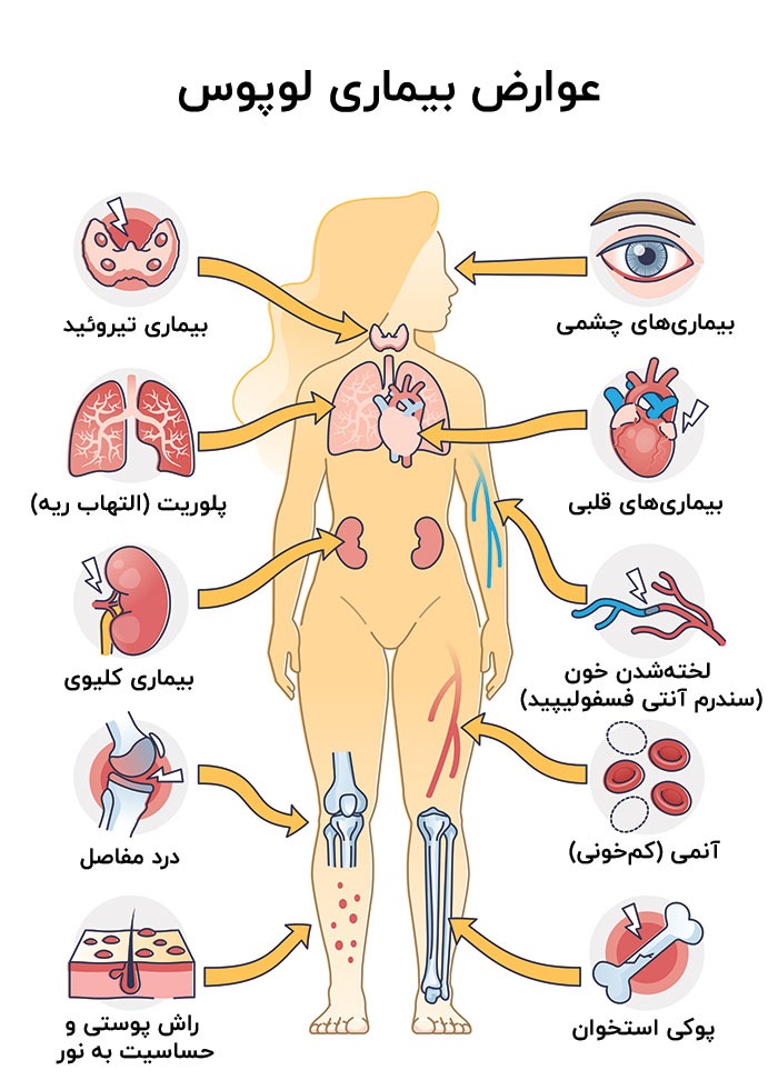 اینفوگرافیک عوارض بیماری لوپوس