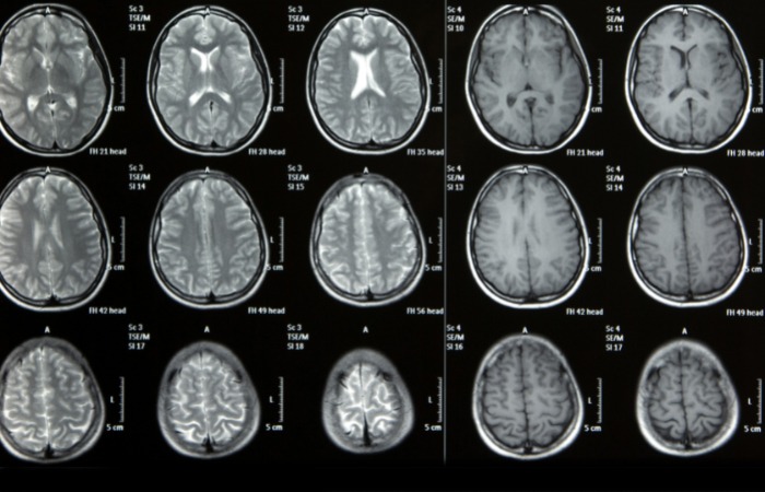 MRI مغز