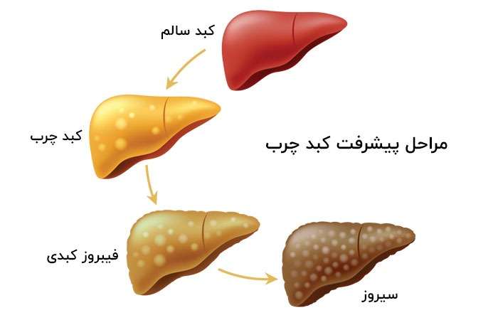 مراحل پیشرفت کبد چرب
