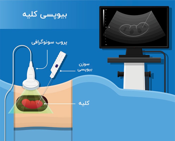 بیوپسی کلیه