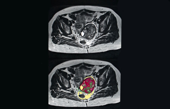 MRI سرطان تخمدان