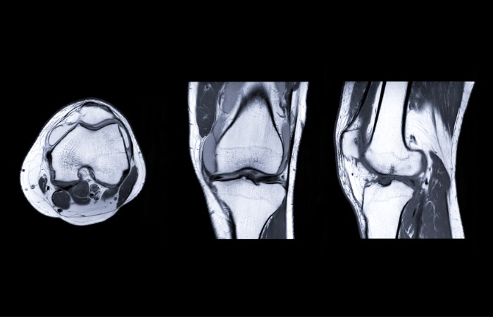 MRI زانو