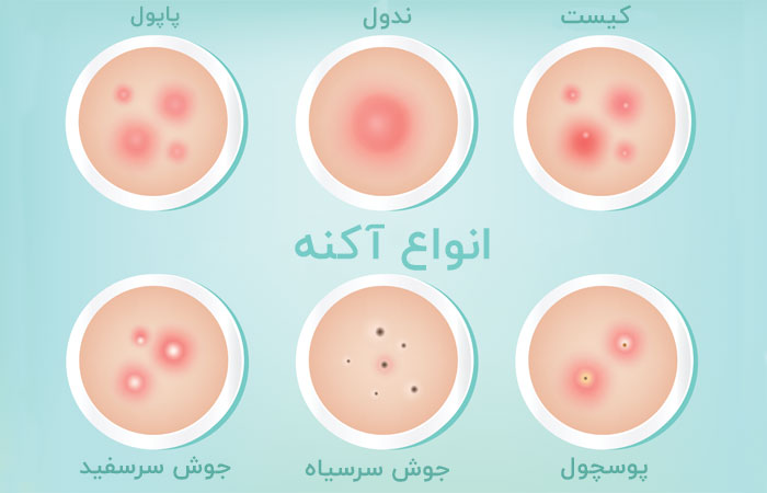 انواع آکنه