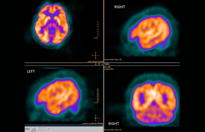PET Scan مغز