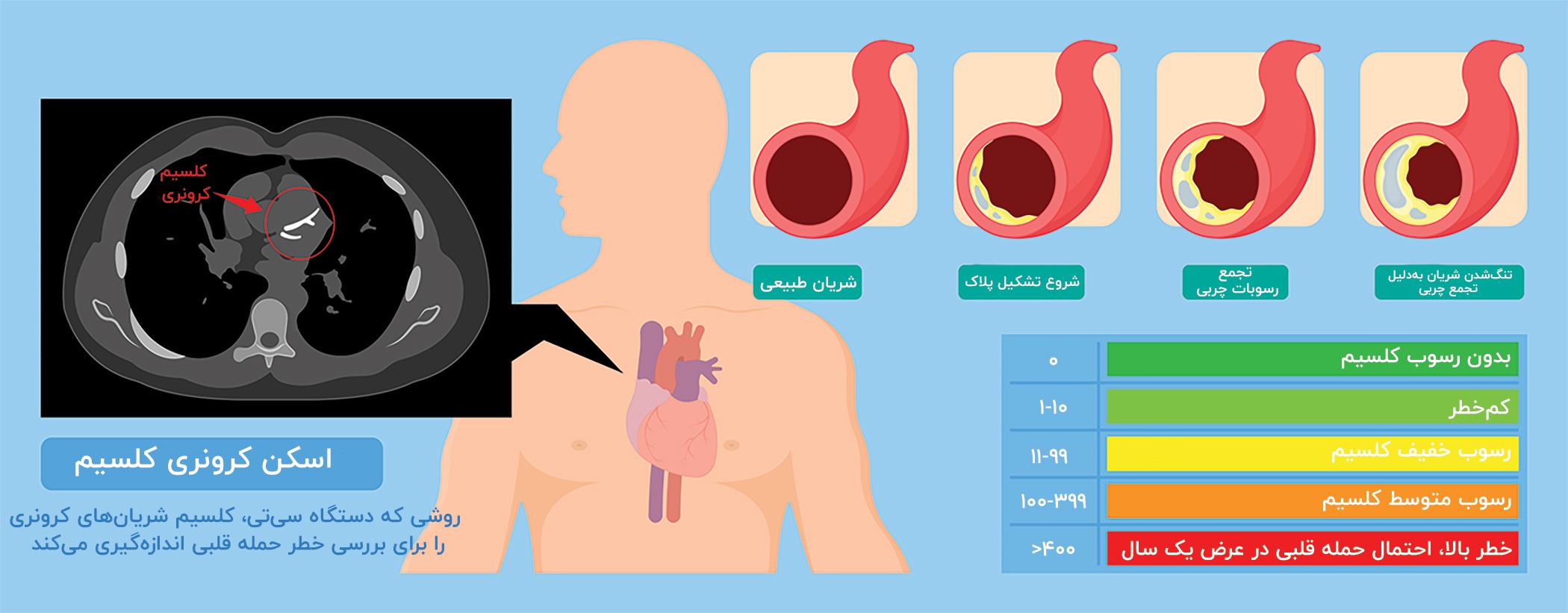 اسکن کرونری کلسیم