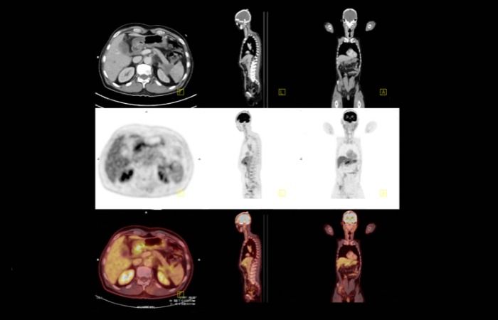 PET Scan تمام بدن