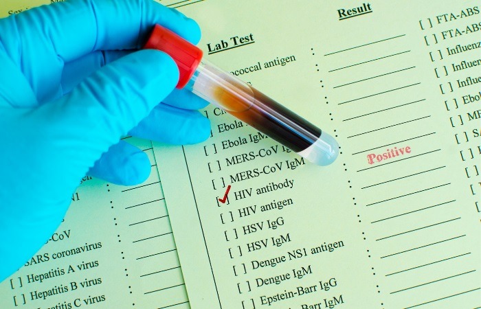 تست آنتی‌بادی HIV