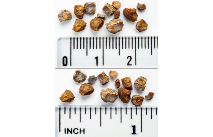 انواع سنگ کلیه
