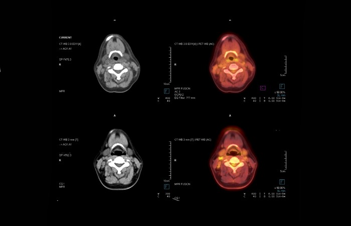 PET CT Scan و CT Scan گردن