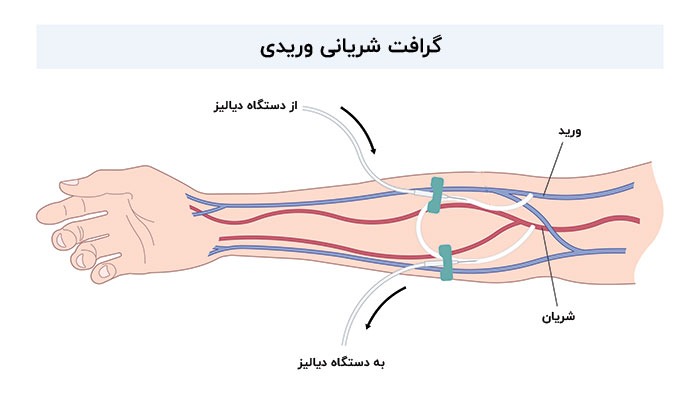 گرافت شریانی وریدی