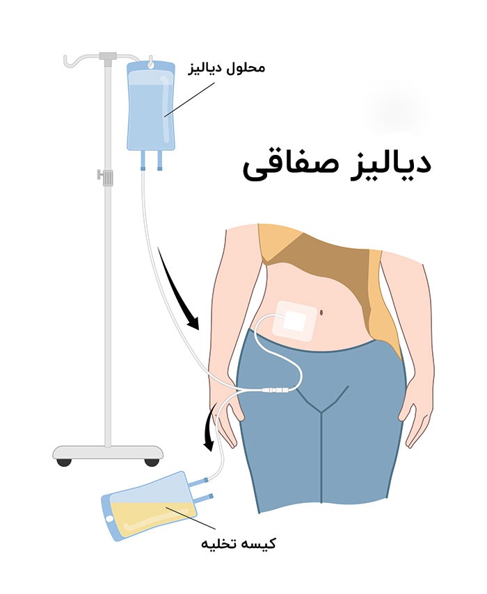 دیالیز صفاقی