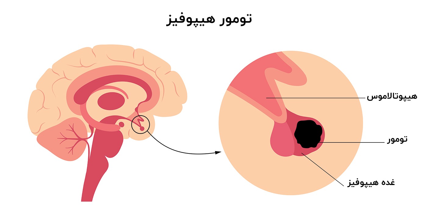 تومور هیپوفیز
