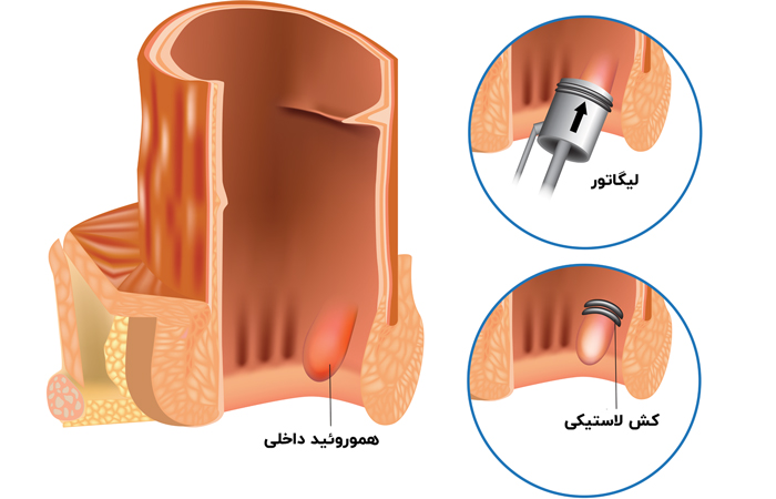 بستن رگ‌ها با کش لاستیکی