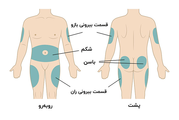 نواحی تزریق انسولین