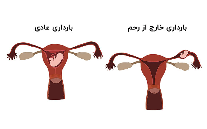 تفاوت بارداری عادی و بارداری خارج رحمی