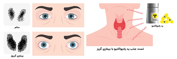 جذب و اسکن تیروئید با ید رادیواکتیو