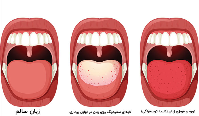 علائم و نشانههای بیماری مخملک