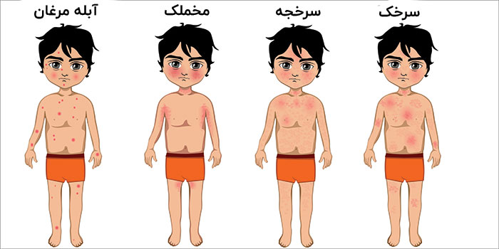 تفاوت بیماری مخملک با سایر بیماریهای مشابه
