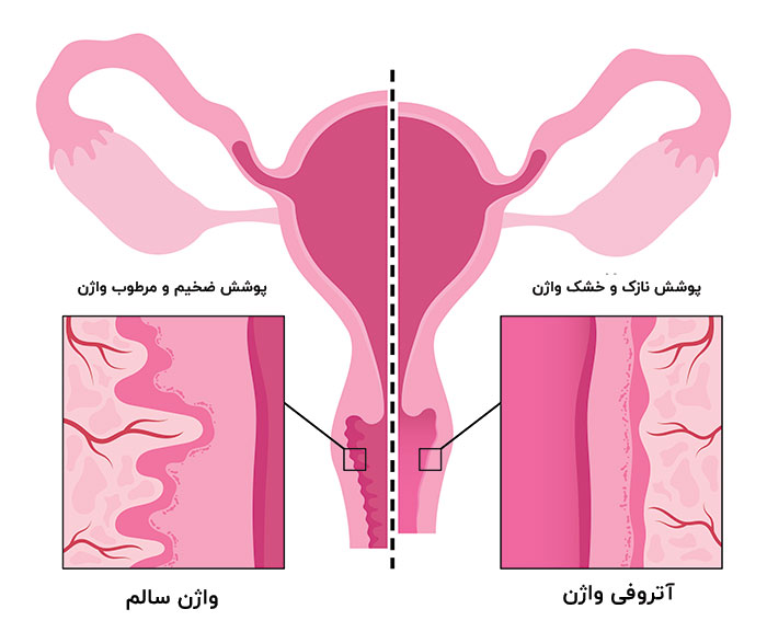 آتروفی واژن و خونریزی بعد از رابطه جنسی