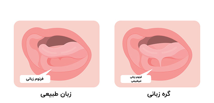 گره زبانی