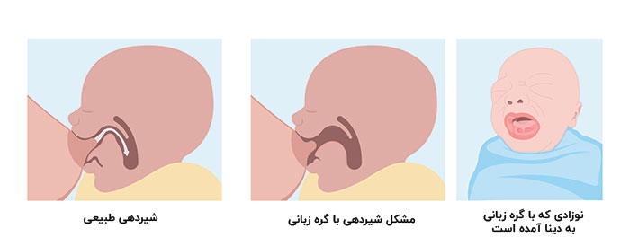 عوارض گره زبانی